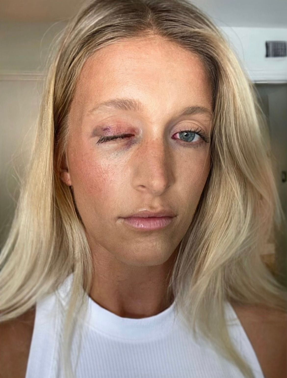 Elizabeth selfie with one eye shut and bruised